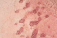 Фото проявления ВПЧ у женщин в виде папиллом на коже