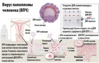 Схема развития вируса папилломы человека у женщин