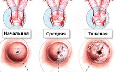 Вирус папилломы человека у женщин на шейке матки: фото ВПЧ ...