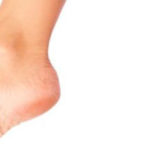 Фото, причины и лечение шипицы на пальце ноги в домашних условиях