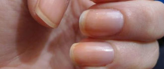 Лечение и фото псориаза ногтей на руках