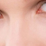 Лечение, фото и причины папилломы на глазу