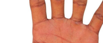 Симптомы, причины, лечение и фото псориаза на руках