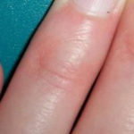 Фото, симптомы и лечение псориаза ногтей