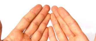 Лечение, причины и фото атопического дерматита на руках